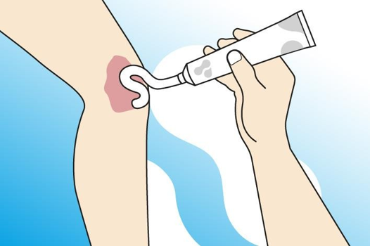 הנחת פלאמינל על פצע